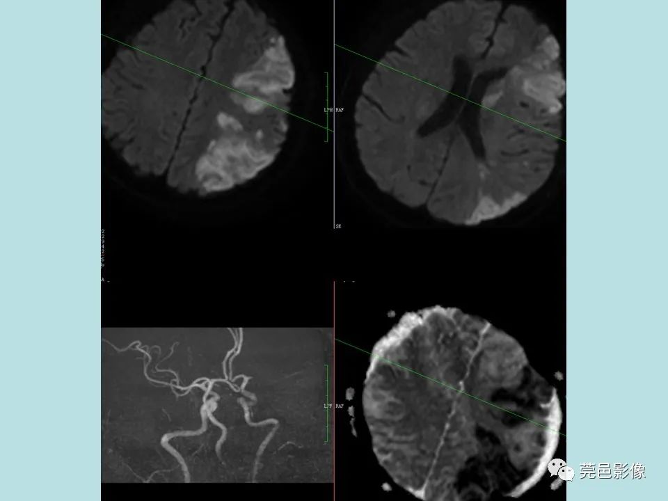 【病例】线粒体脑肌病1例CT及MR-29
