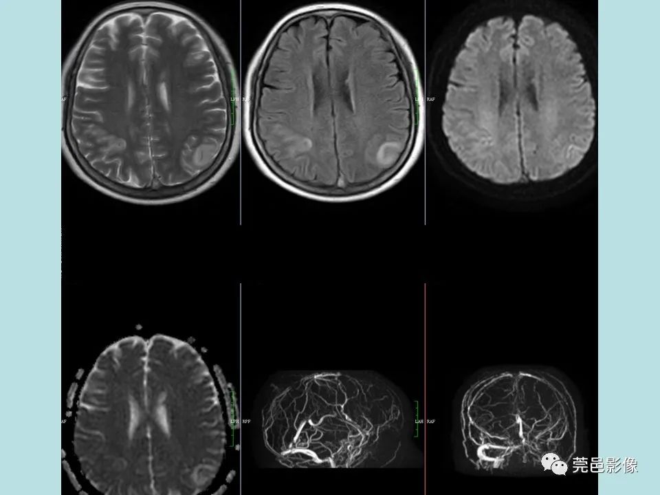 【病例】线粒体脑肌病1例CT及MR-30