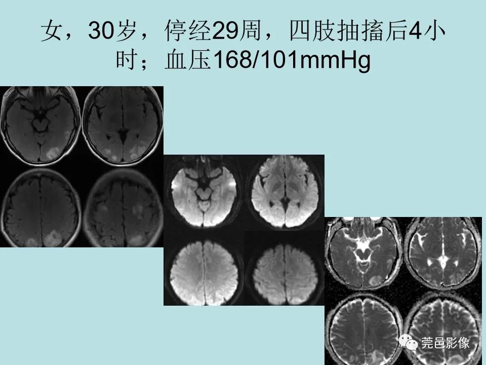 【病例】线粒体脑肌病1例CT及MR-32