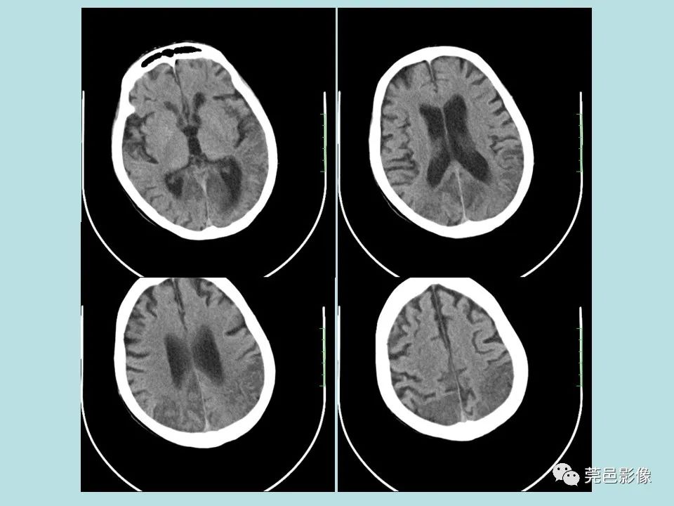 【病例】线粒体脑肌病1例CT及MR-1