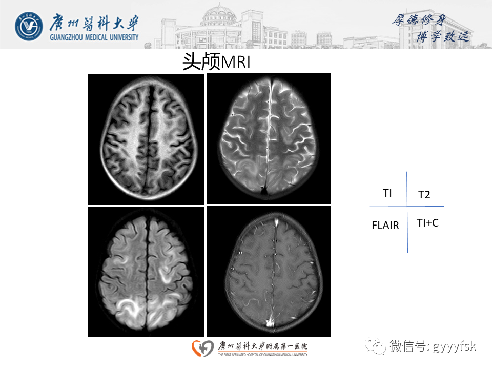 【病例】可逆性后部脑病综合征（PRES）一例MR-5