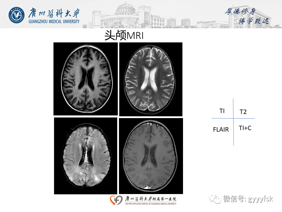 【病例】可逆性后部脑病综合征（PRES）一例MR-6