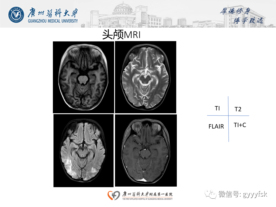 【病例】可逆性后部脑病综合征（PRES）一例MR-7