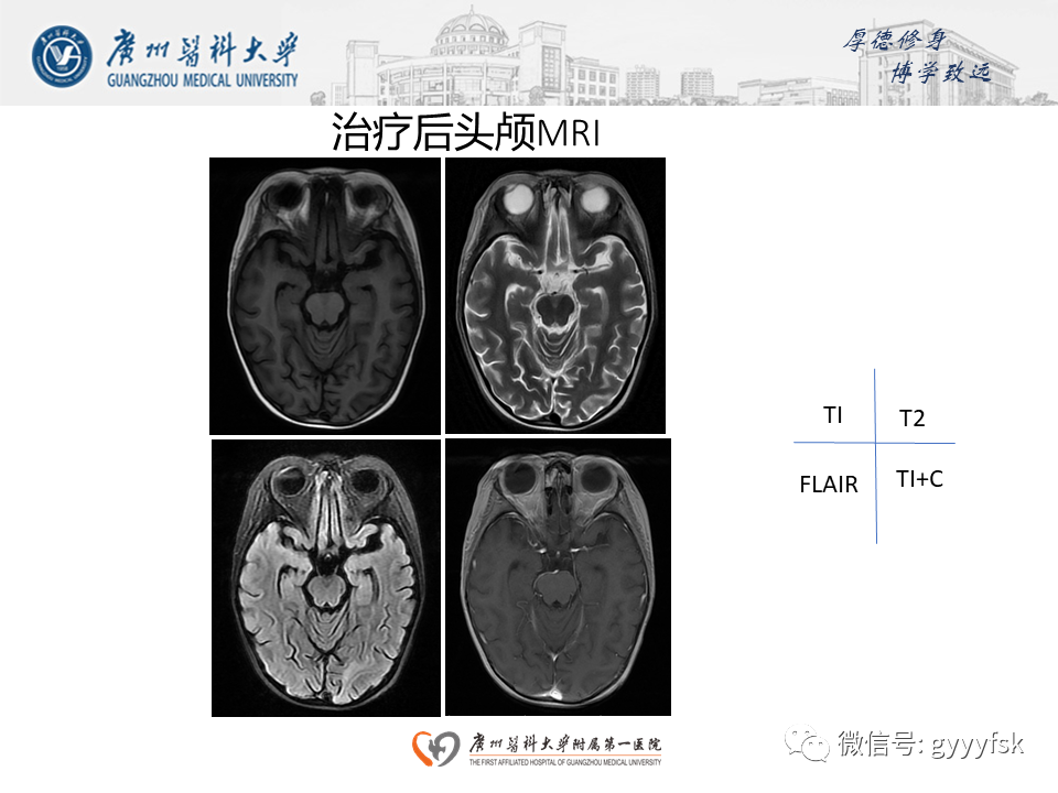 【病例】可逆性后部脑病综合征（PRES）一例MR-13