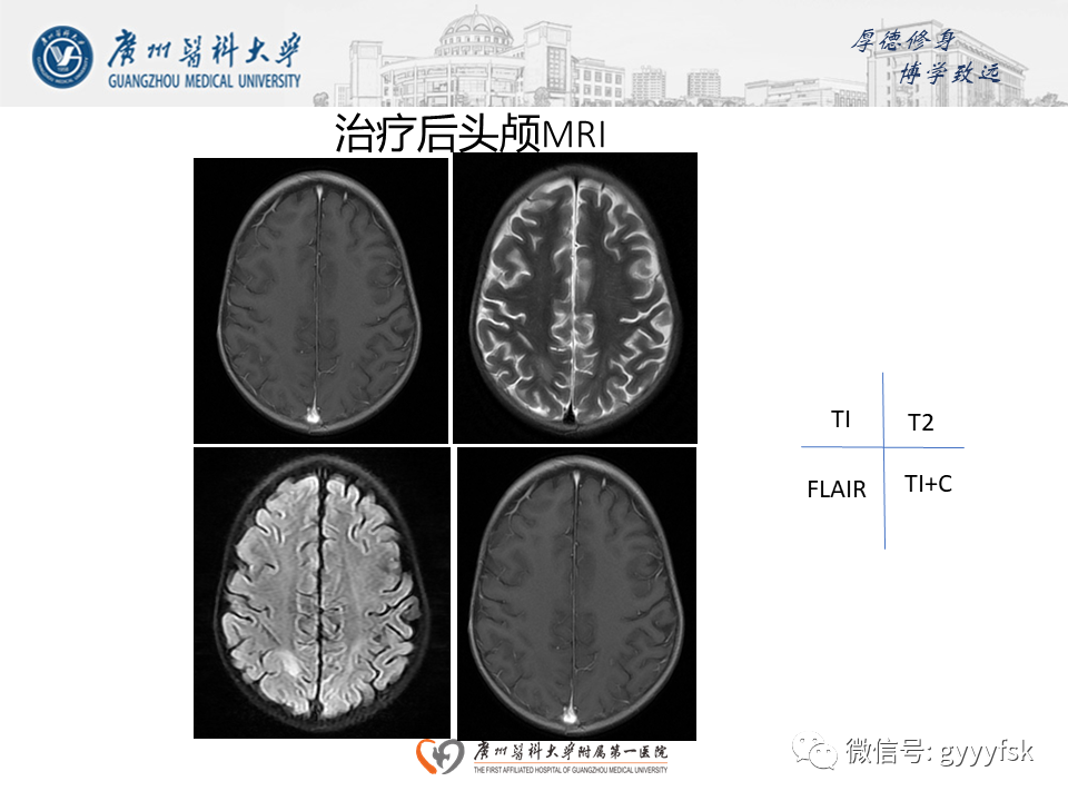 【病例】可逆性后部脑病综合征（PRES）一例MR-11
