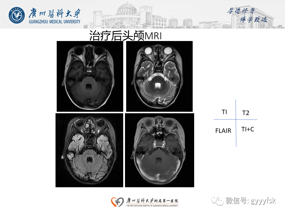 【病例】可逆性后部脑病综合征（PRES）一例MR-14