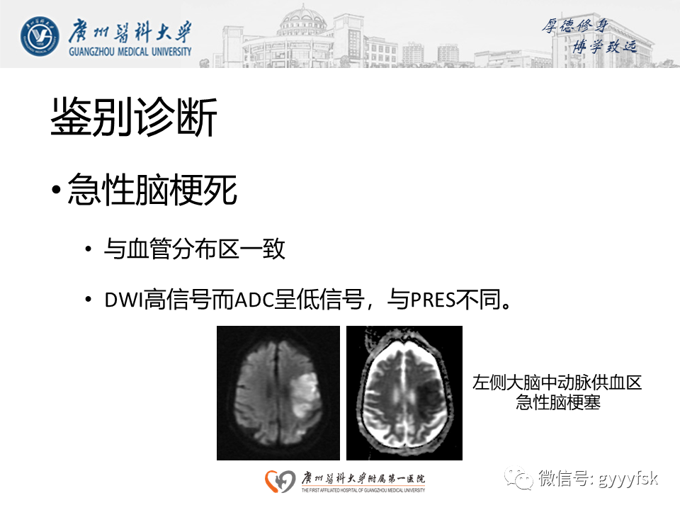 【病例】可逆性后部脑病综合征（PRES）一例MR-18