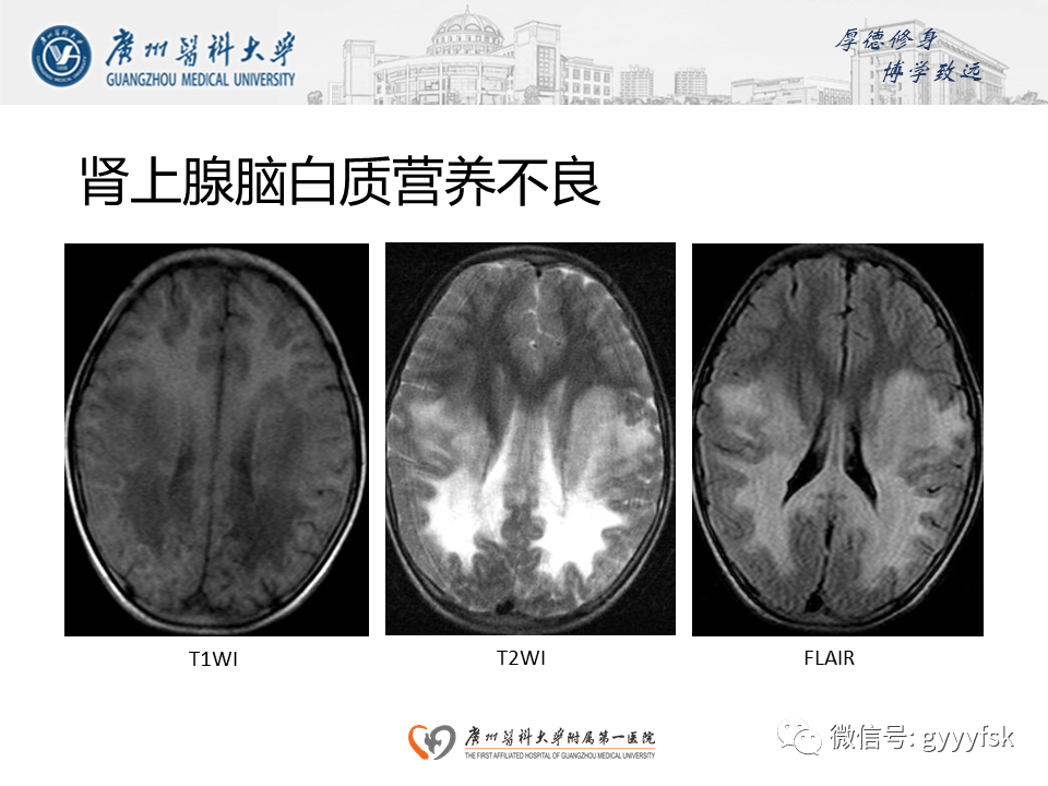 【病例】可逆性后部脑病综合征（PRES）一例MR-20
