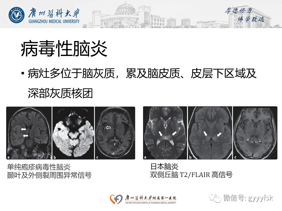 【病例】可逆性后部脑病综合征（PRES）一例MR-21