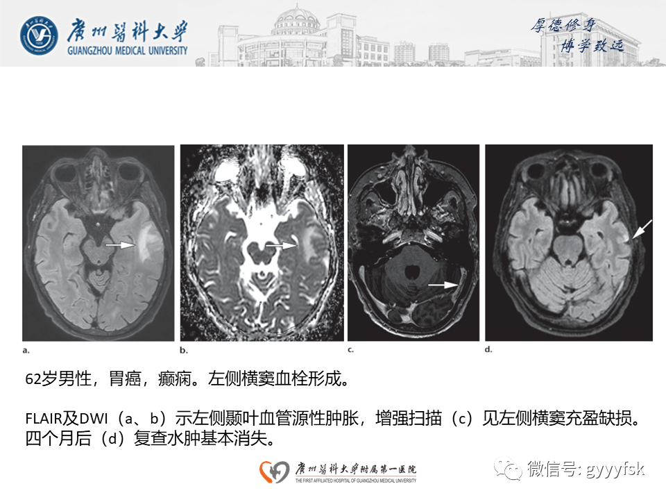 【病例】可逆性后部脑病综合征（PRES）一例MR-23