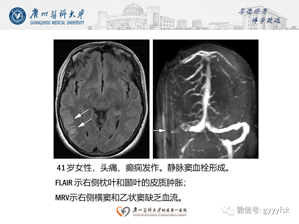 【病例】可逆性后部脑病综合征（PRES）一例MR-24