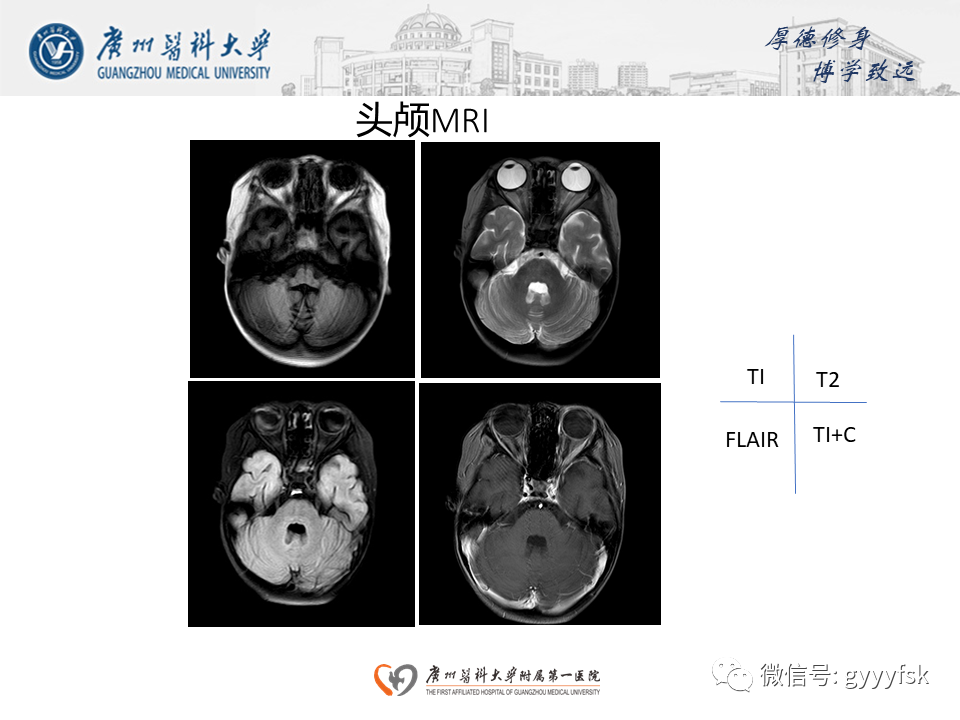 【病例】可逆性后部脑病综合征（PRES）一例MR-1