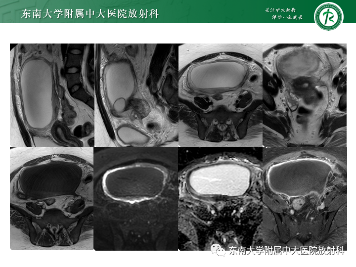 【病例】附件扭转4例病例随访-2
