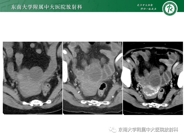 【病例】附件扭转4例病例随访-5