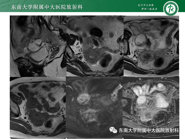 【病例】附件扭转4例病例随访-6