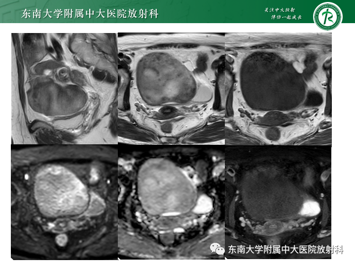 【病例】附件扭转4例病例随访-9