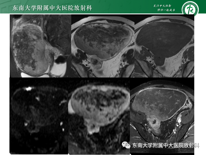 【病例】附件扭转4例病例随访-12