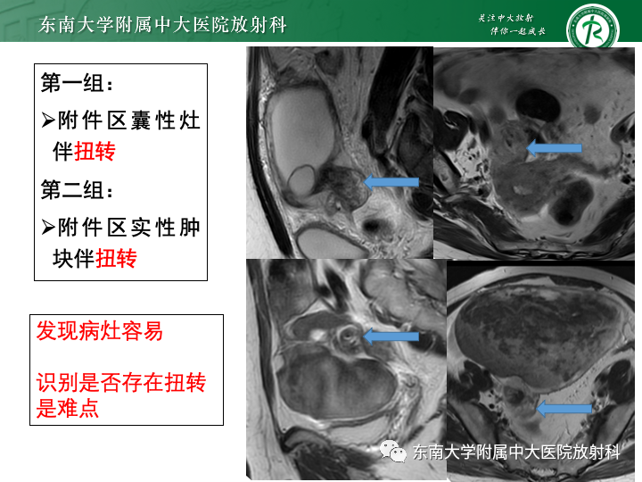 【病例】附件扭转4例病例随访-17