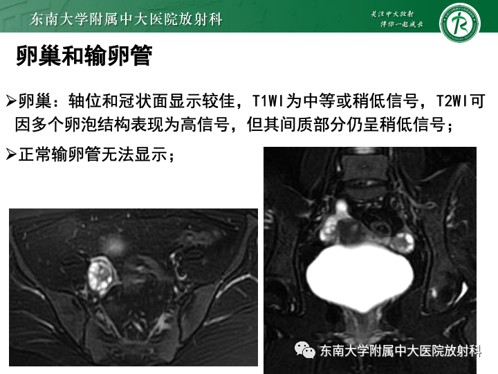 【病例】附件扭转4例病例随访-19