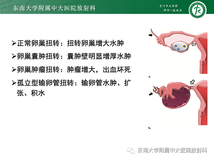 【病例】附件扭转4例病例随访-26