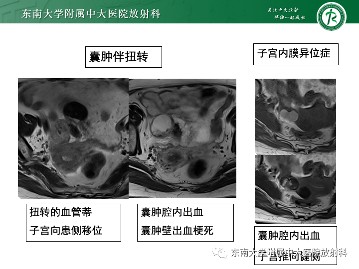 【病例】附件扭转4例病例随访-29