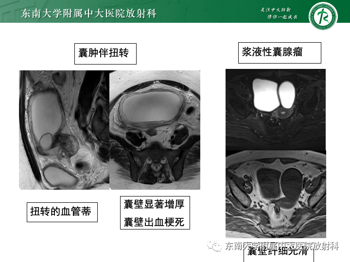【病例】附件扭转4例病例随访-30