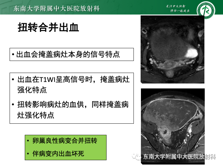 【病例】附件扭转4例病例随访-31