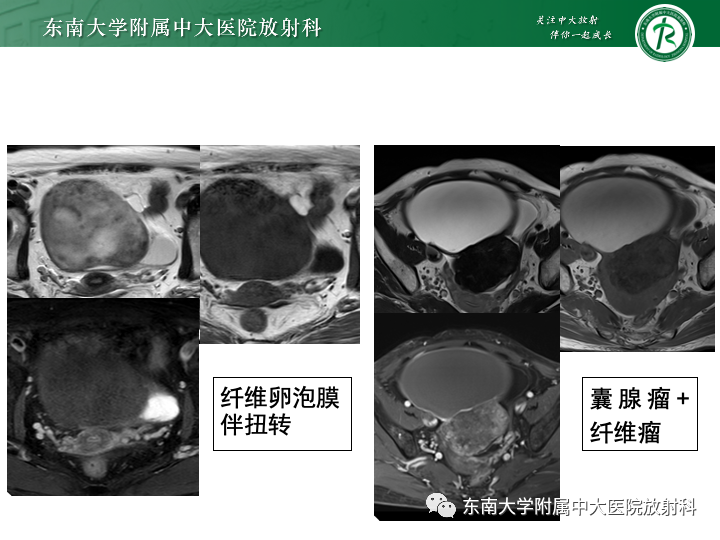 【病例】附件扭转4例病例随访-32