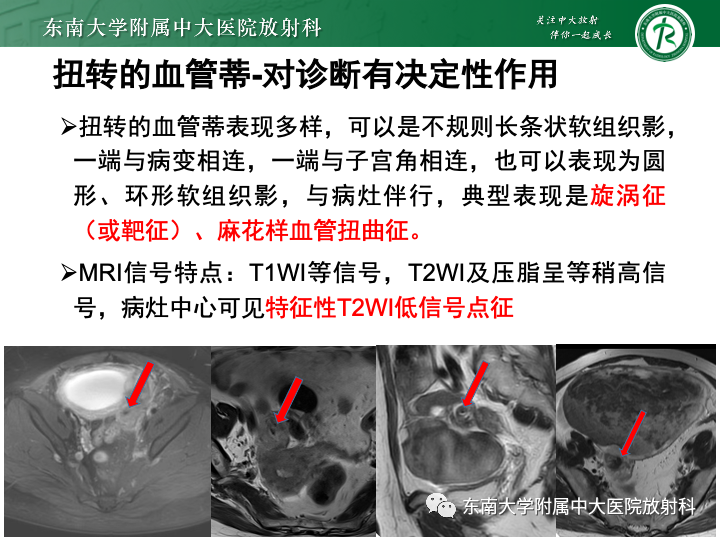 【病例】附件扭转4例病例随访-33