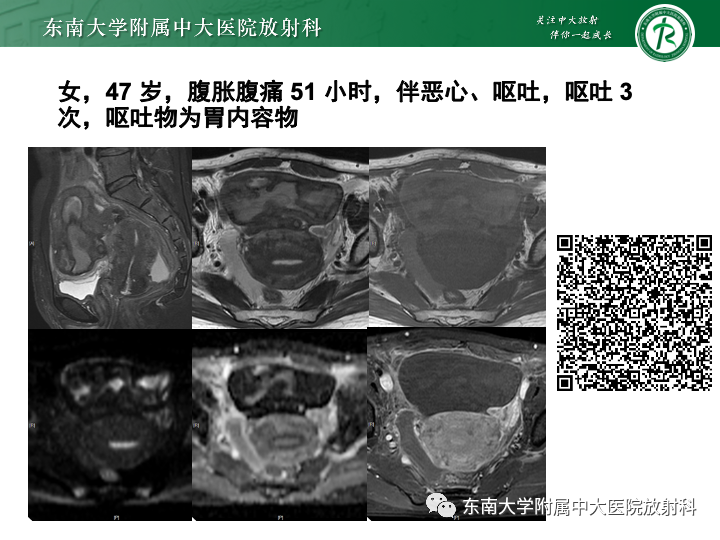 【病例】附件扭转4例病例随访-34