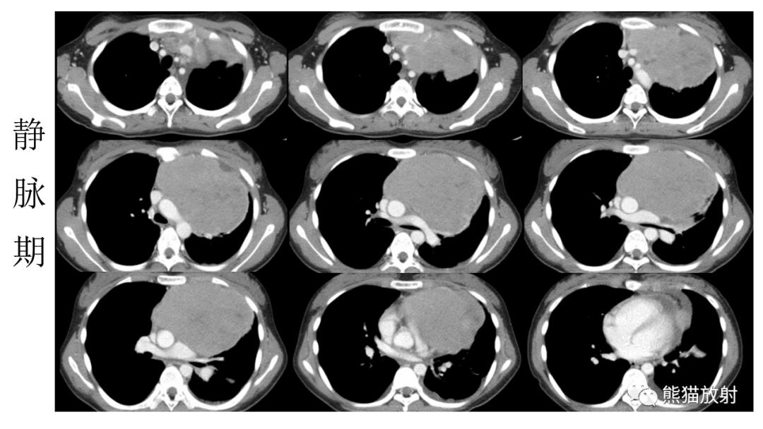 【PPT】儿童及青少年前纵隔肿瘤-5