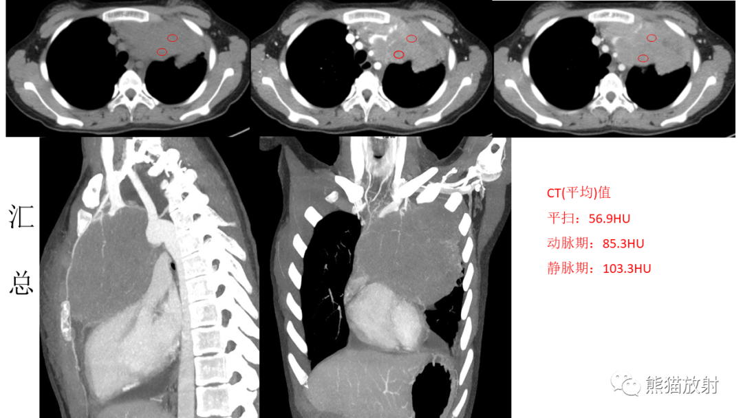 【PPT】儿童及青少年前纵隔肿瘤-4