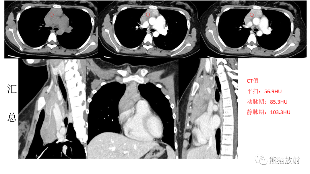 【PPT】儿童及青少年前纵隔肿瘤-9