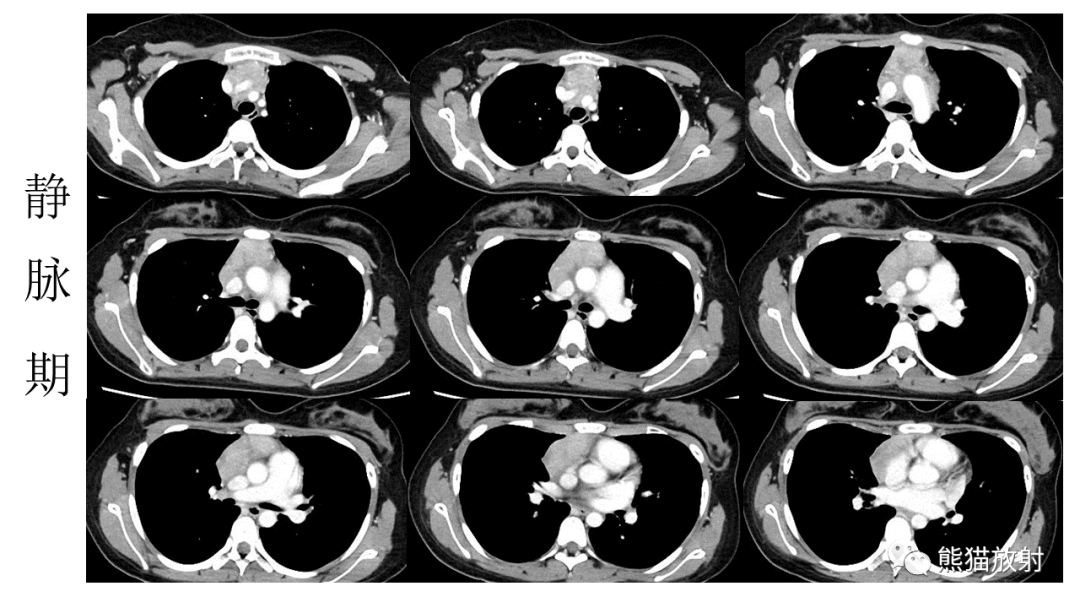 【PPT】儿童及青少年前纵隔肿瘤-10
