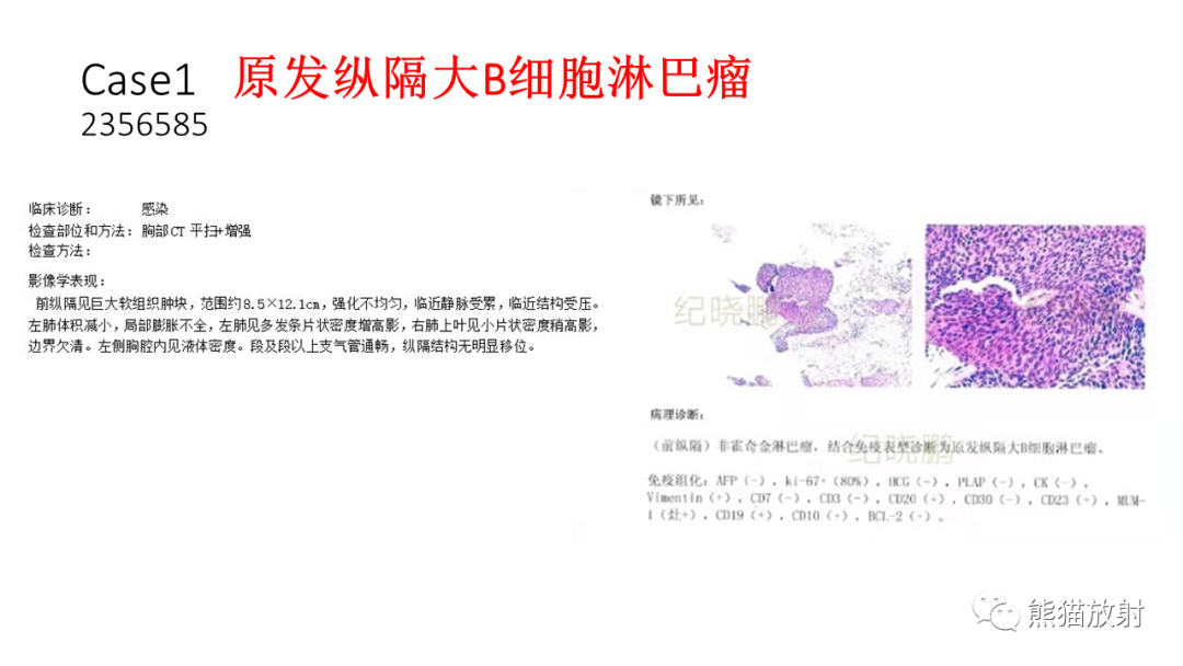 【PPT】儿童及青少年前纵隔肿瘤-12