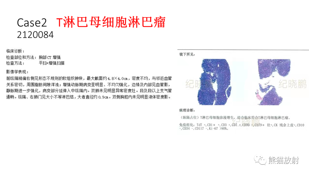 【PPT】儿童及青少年前纵隔肿瘤-13