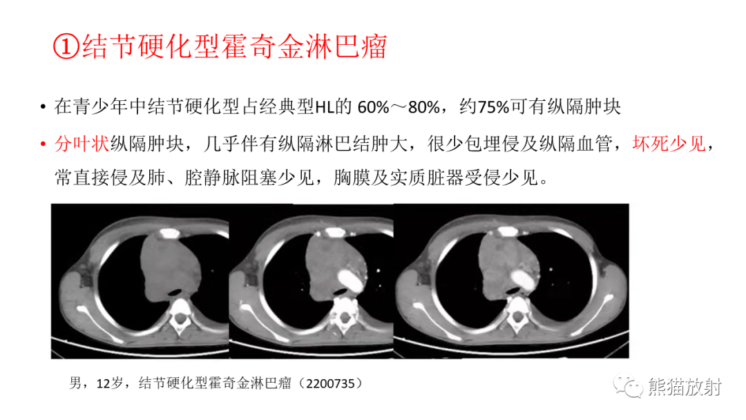 【PPT】儿童及青少年前纵隔肿瘤-21