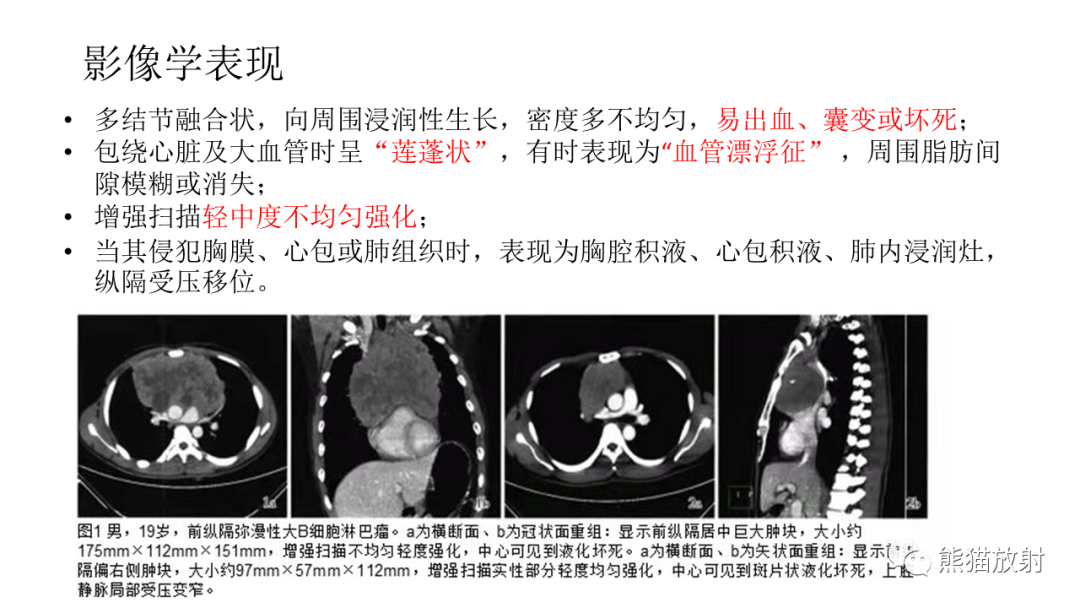 【PPT】儿童及青少年前纵隔肿瘤-23