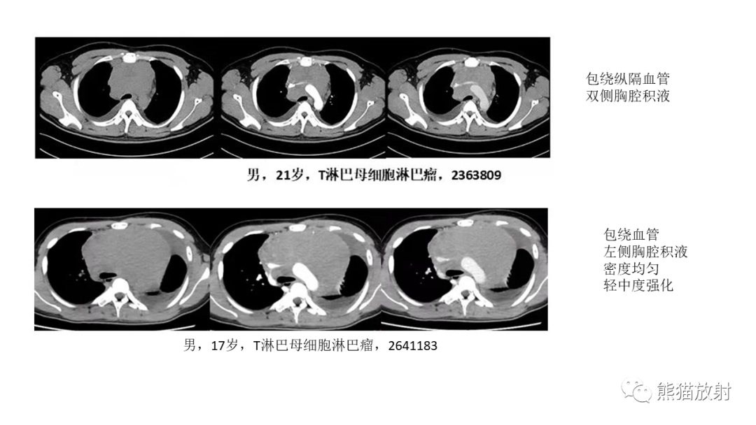 【PPT】儿童及青少年前纵隔肿瘤-26