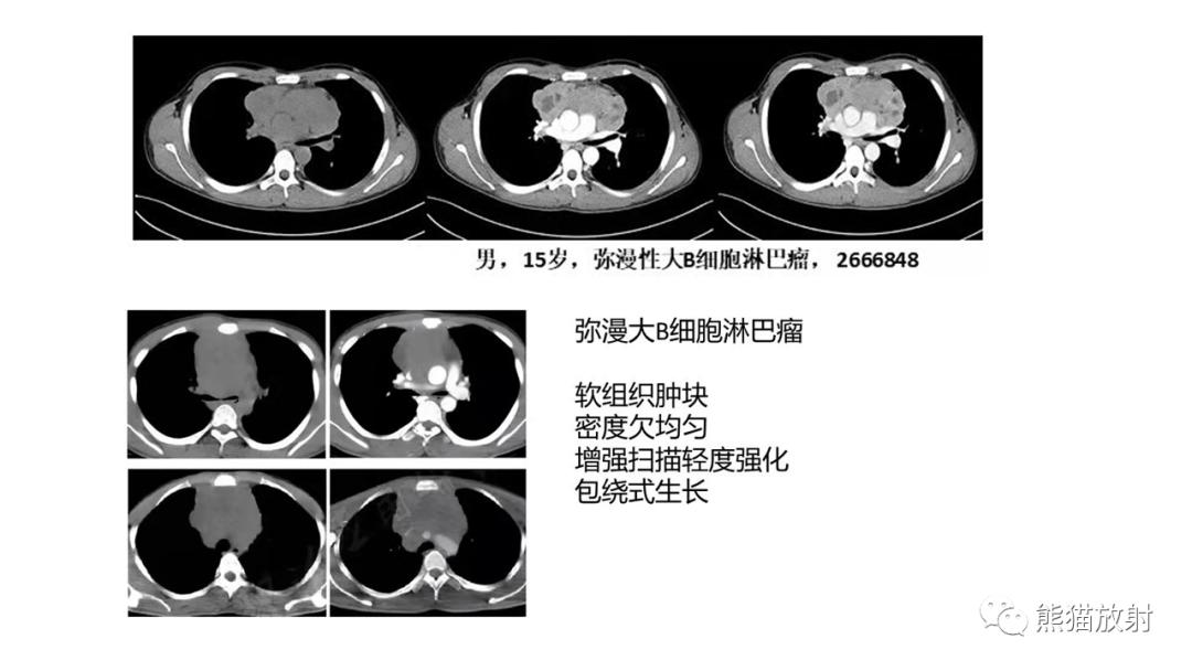 【PPT】儿童及青少年前纵隔肿瘤-24