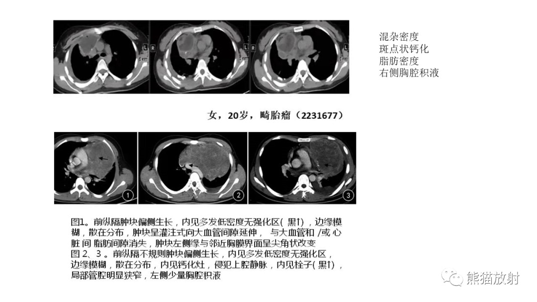 【PPT】儿童及青少年前纵隔肿瘤-30