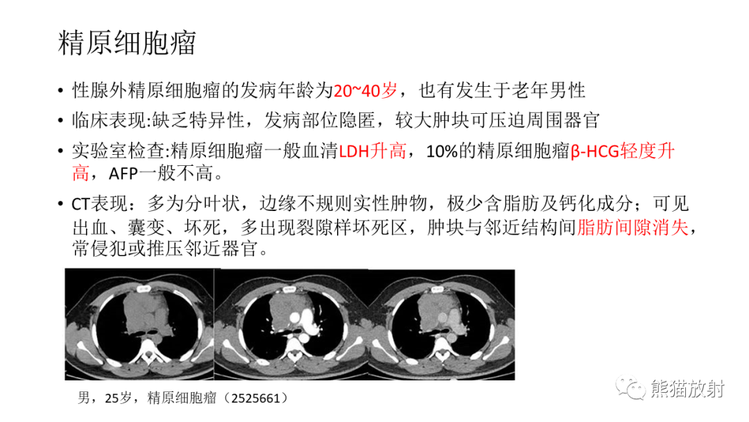 【PPT】儿童及青少年前纵隔肿瘤-31