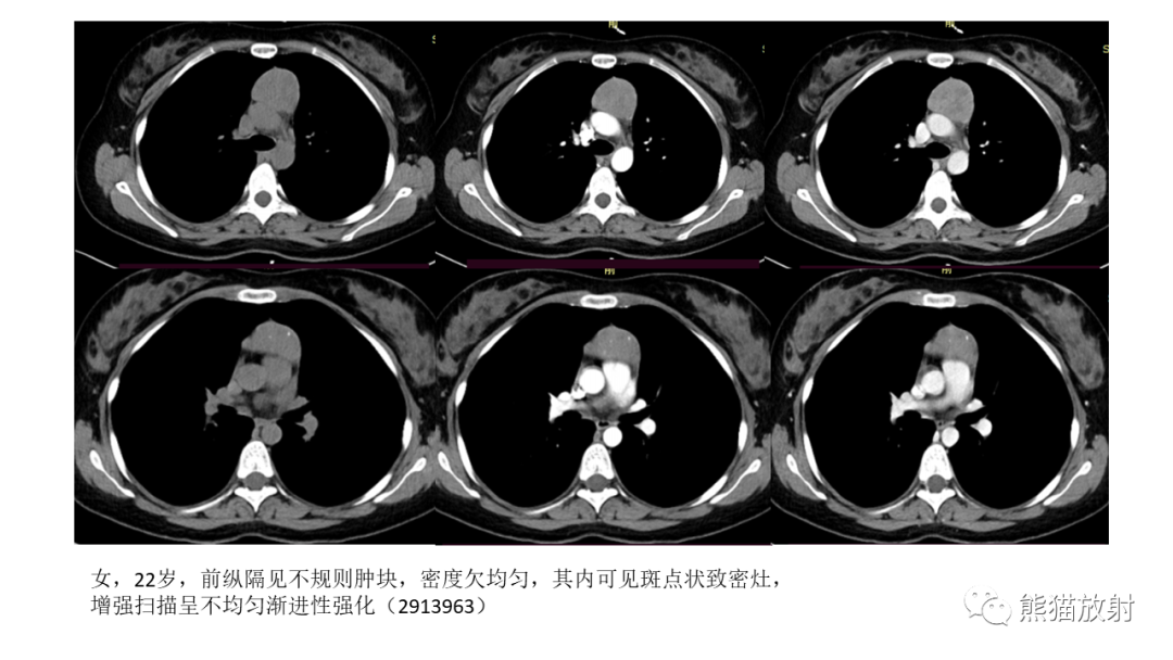 【PPT】儿童及青少年前纵隔肿瘤-34
