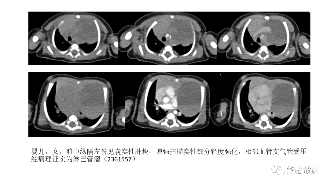 【PPT】儿童及青少年前纵隔肿瘤-39