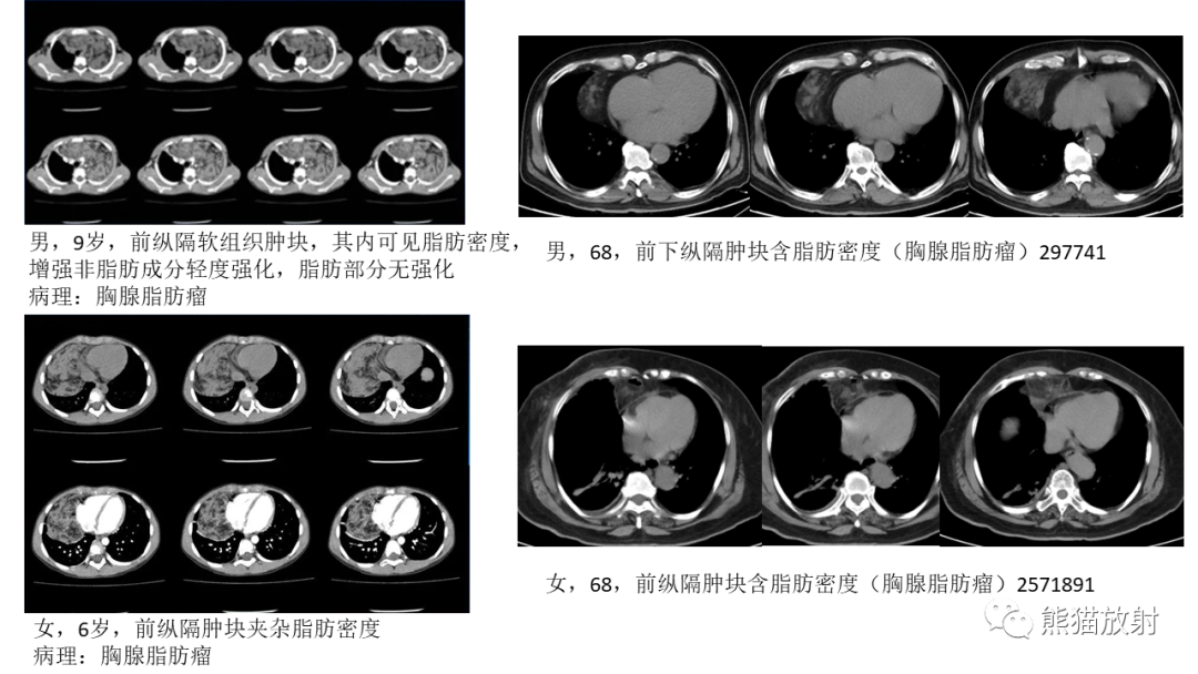 【PPT】儿童及青少年前纵隔肿瘤-41