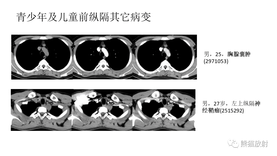 【PPT】儿童及青少年前纵隔肿瘤-42