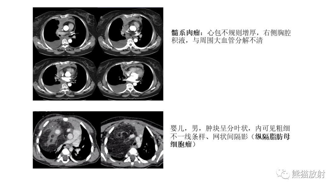 【PPT】儿童及青少年前纵隔肿瘤-43