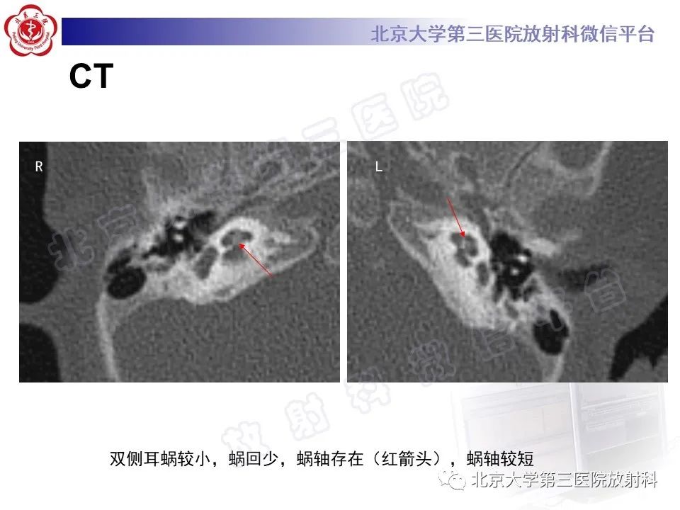 【PPT】内耳发育畸形-3