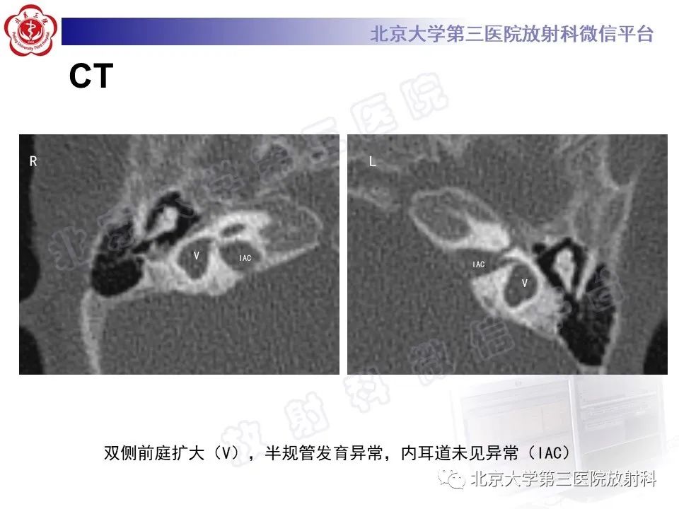 【PPT】内耳发育畸形-4