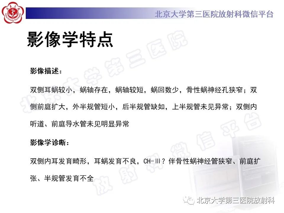 【PPT】内耳发育畸形-6